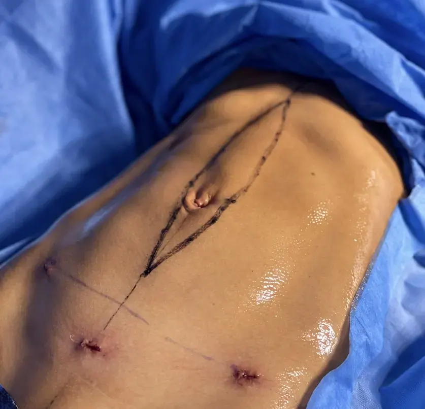 Imagem clínica de diástase abdominal