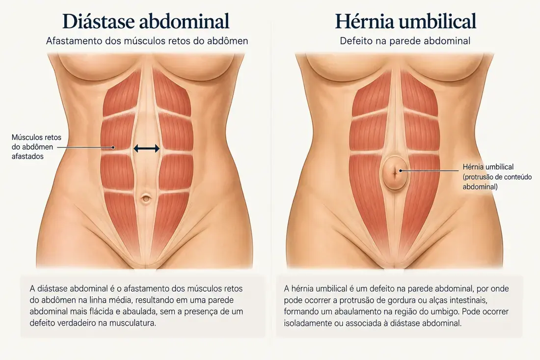 Comparação educativa entre diástase abdominal e hérnia umbilical